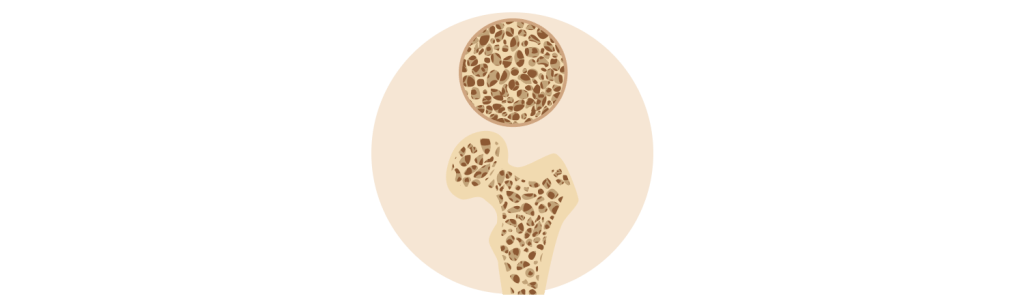 Osteoporosis and Calcium Disorders