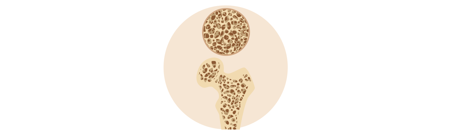 Osteoporosis and Calcium Disorders