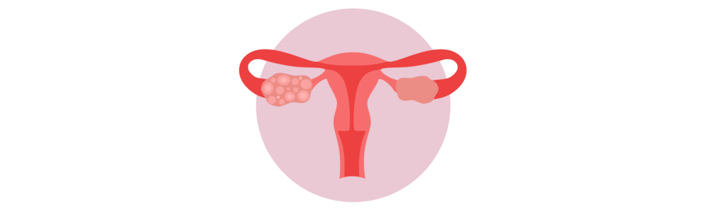 Polycystic Ovarian Syndrome