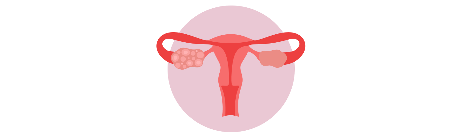 Polycystic Ovarian Syndrome