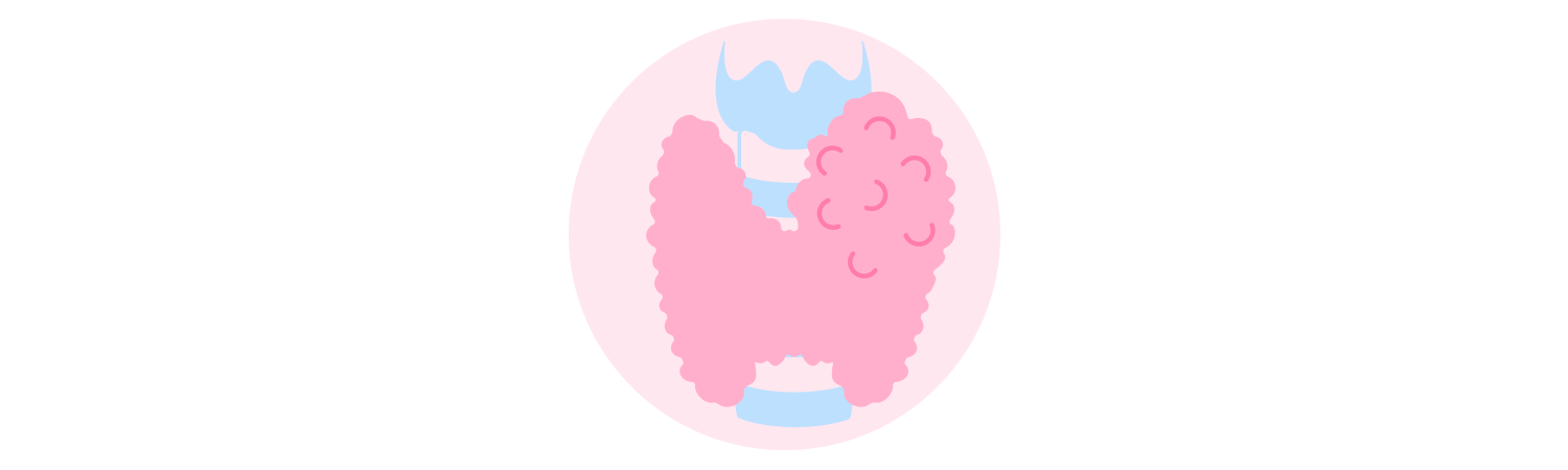 Thyroid nodules and cancer